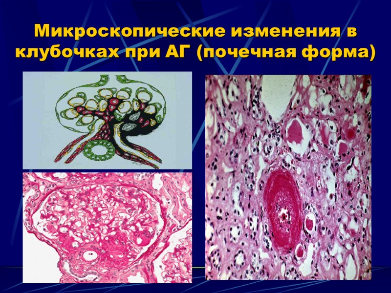 Микроскопические изменения в клубочках при АГ (почечная форма)